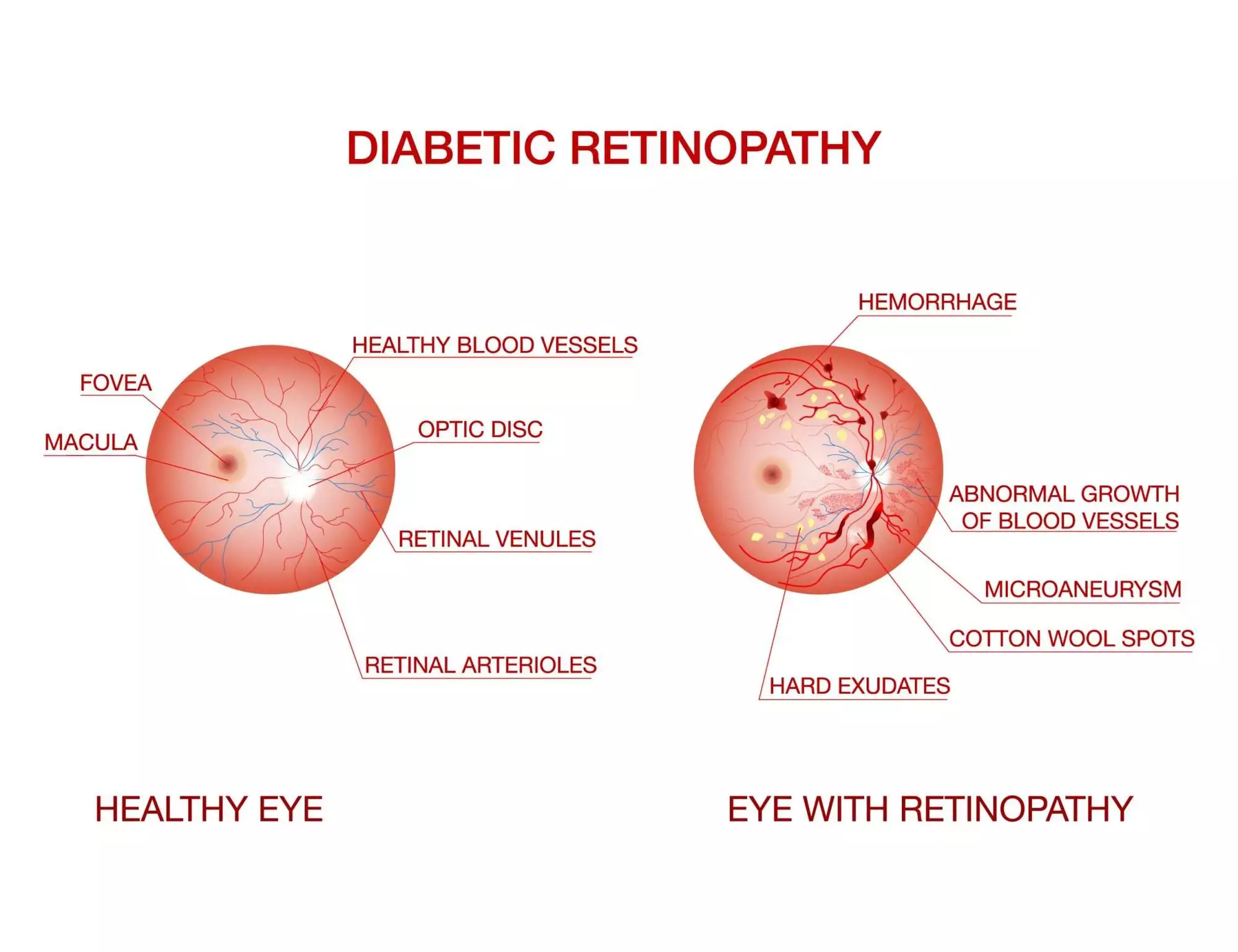 diabetic retinopathy treatment in Mumbai- Dr Anurag S Agarwal Eye Clinic