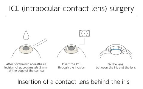 Laser Cataract Surgery in Mumbai Procedure