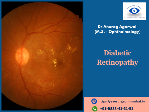 Diabetic retinopathy Treatment in Mumbai