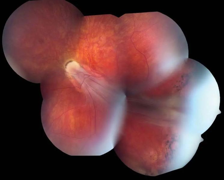 Retinopathy of prematurity