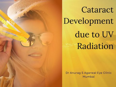 Cataract development and UV rays