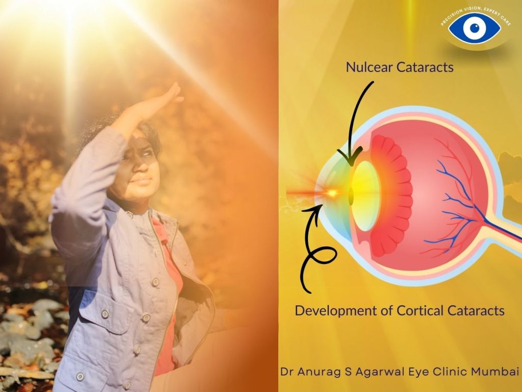 Cataracts due to UV rays
