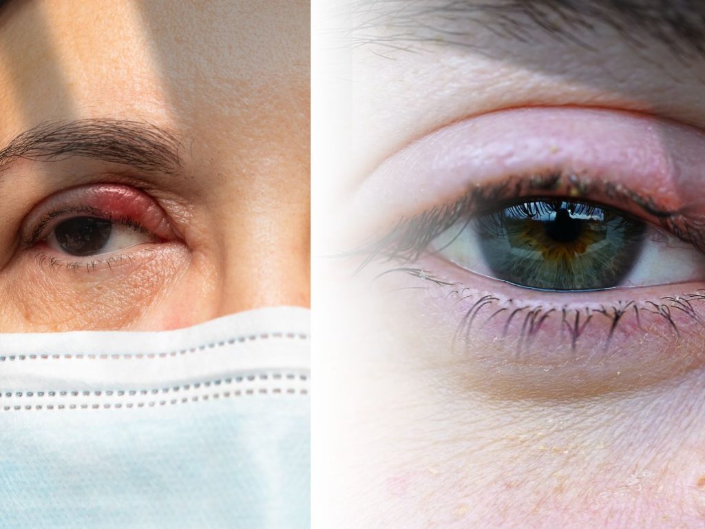 Stye treatment - eyelid infection
