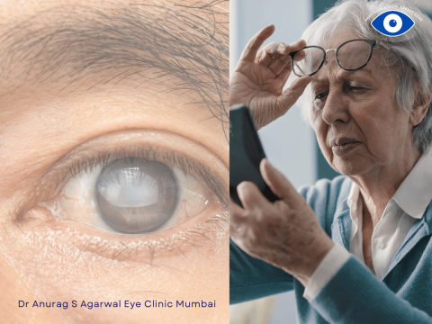 Diabetic Cataract Treatment in Mumbai
